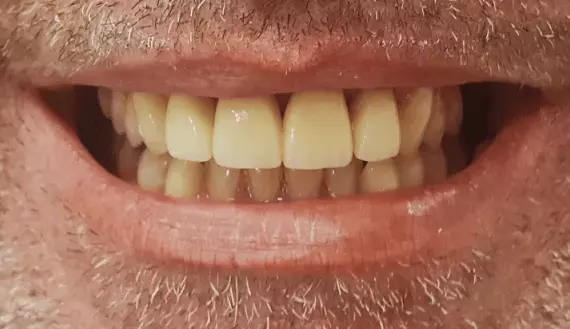 fix-yellow-teeth