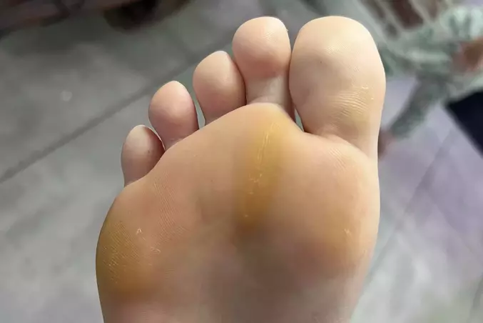 Why Are The Bottom Of My Feet Yellow New Gen Men