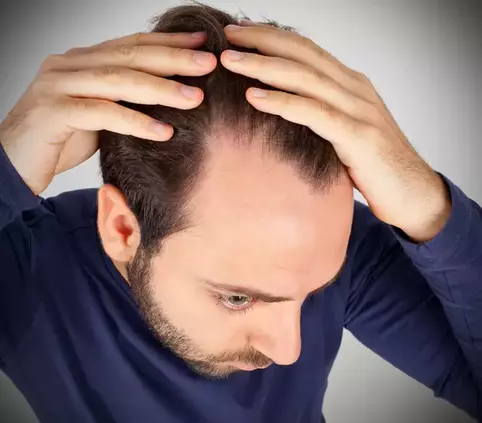 how to stop receding hairline